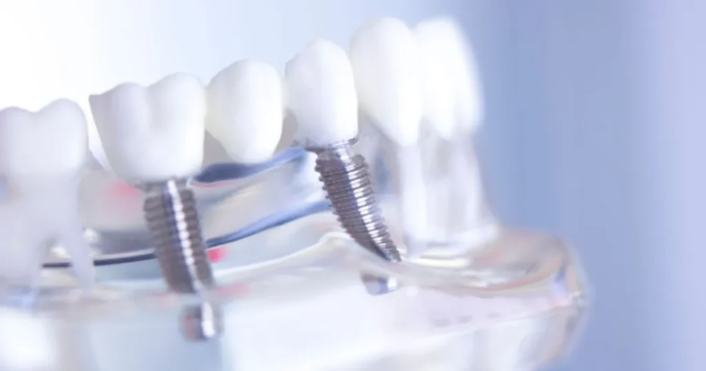 immagine di un impianto dentale